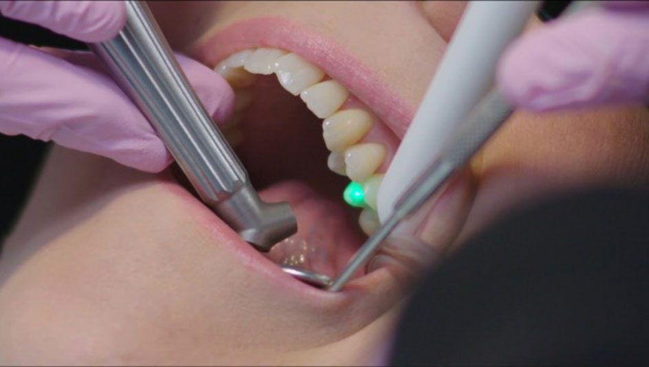 Laser Fillings